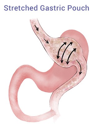 Stretched Gastric Pouch