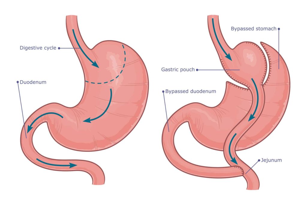 gastric bypass surgery