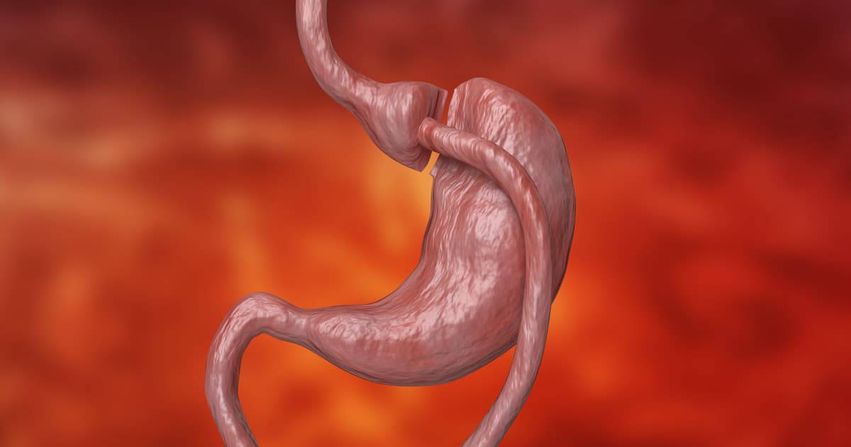 gastric bypass stomach