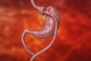 gastric bypass stomach