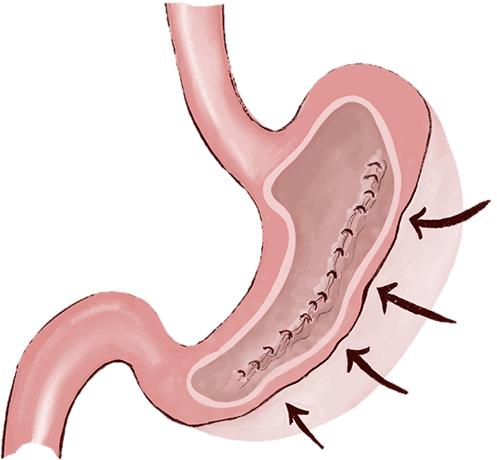 Illustraion of stomach after ESG procedure