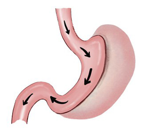 Gastric sleeve