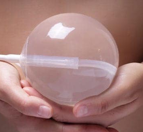 Gastric Balloon