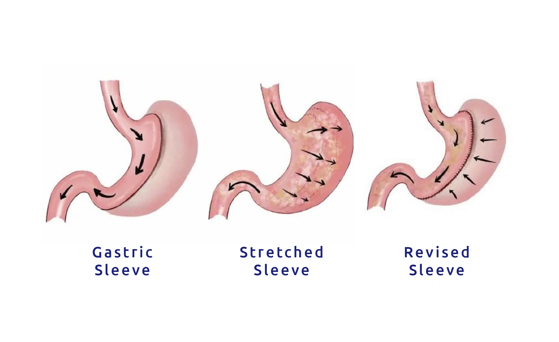 a diagram of gastric sleeve