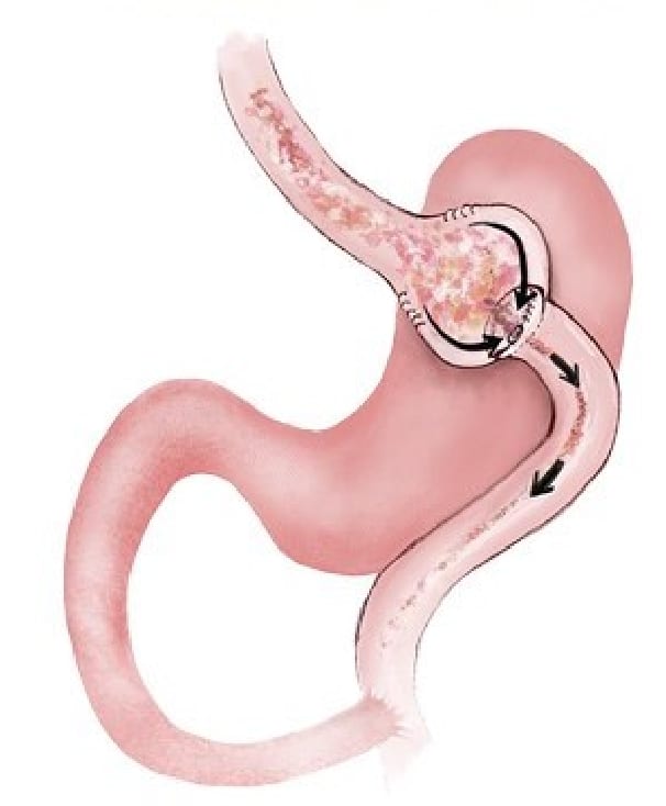 Endoscopic Gastric