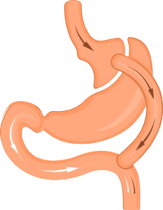 About Gastric Bypass Revisions