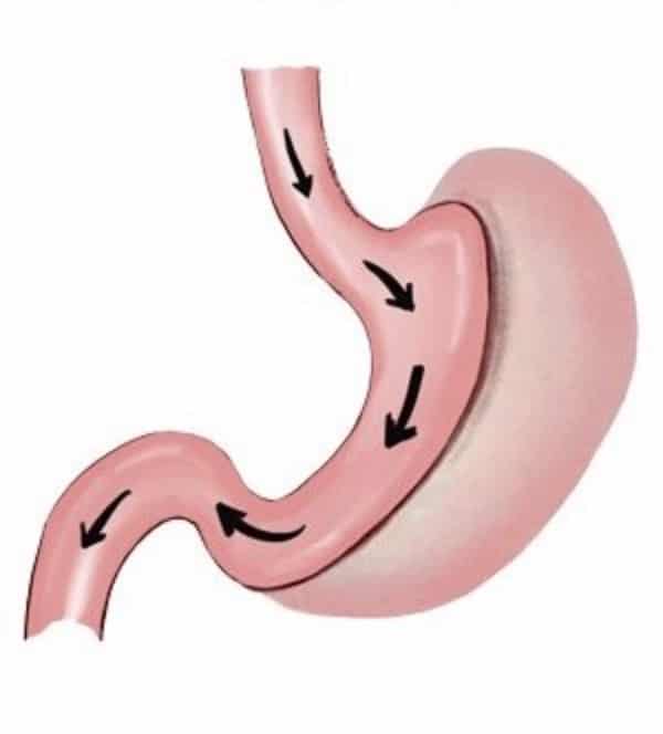 gastric sleeve surgery