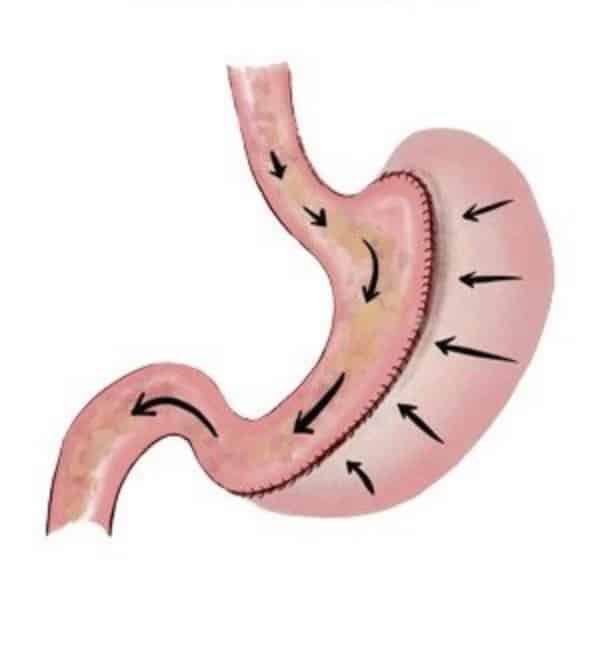 gastric sleeve surgery