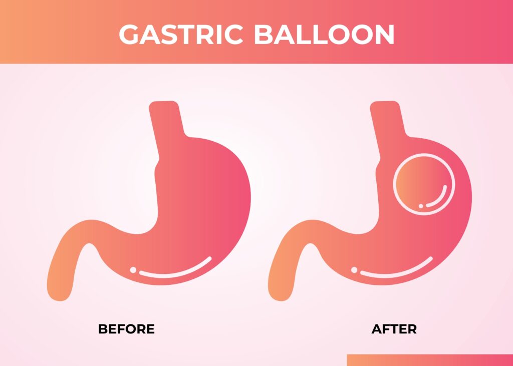 gastric balloon diagram