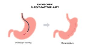 esg procedure