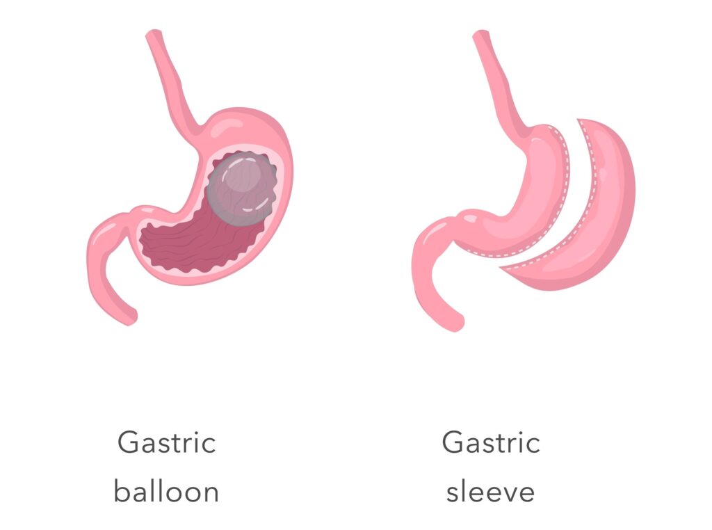 manga gástrica vs balón gástrico