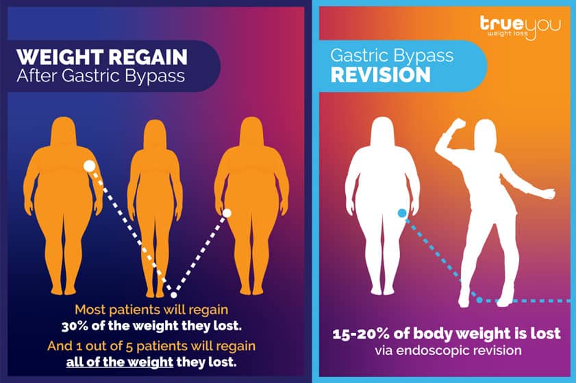 Take Two Gastric Bypass Revision Explained True You Weight Loss