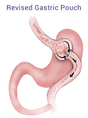 Revised Gastric Pouch